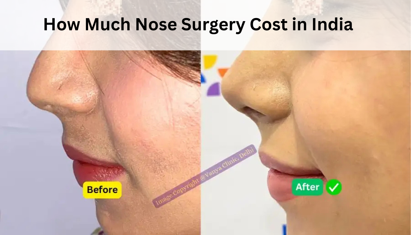 How Much Nose Surgery Cost in India A Complete 2025 Guide