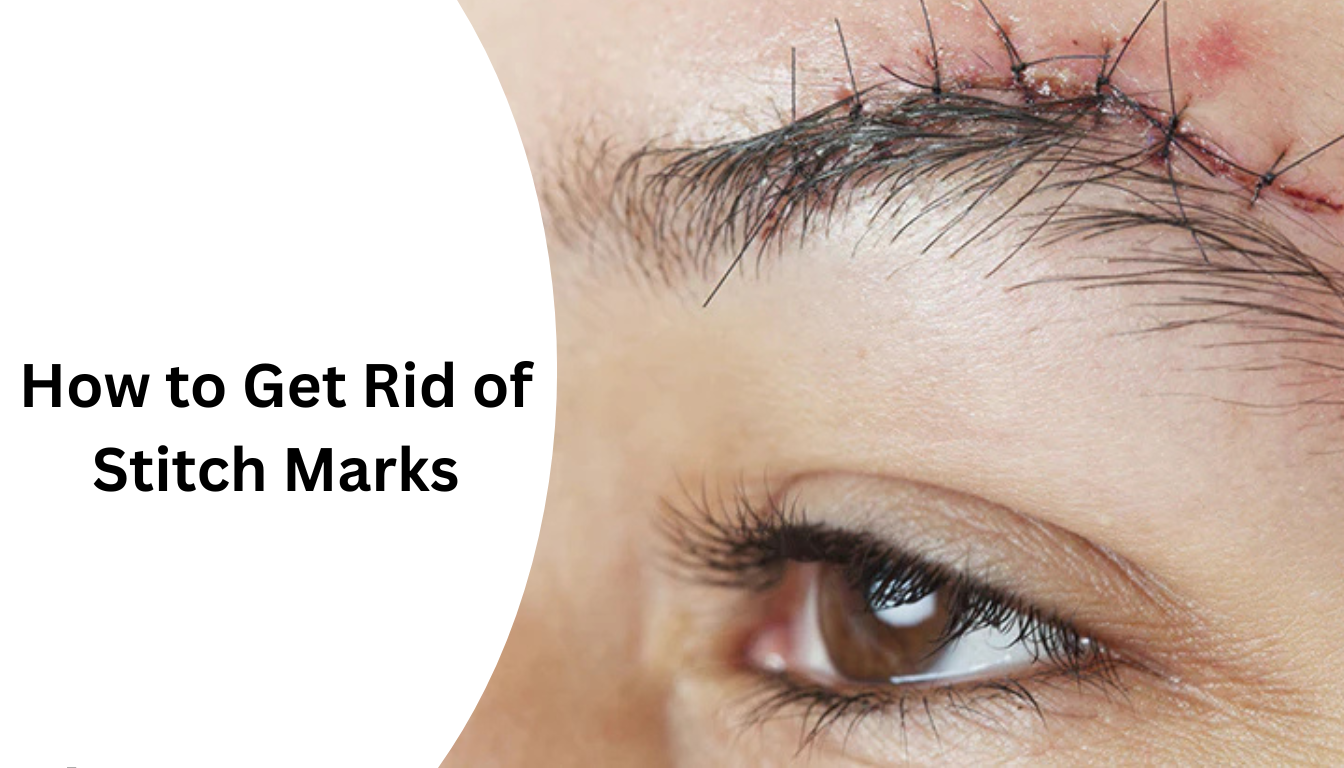 How to Get Rid of Stitch Marks in India: Natural & Medical Solutions
